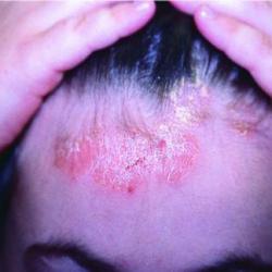 Example of psoriasis
